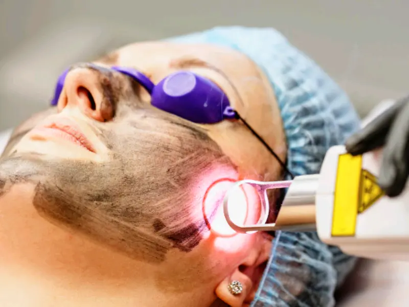 Hollywood Peel - Tratamiento facial láser